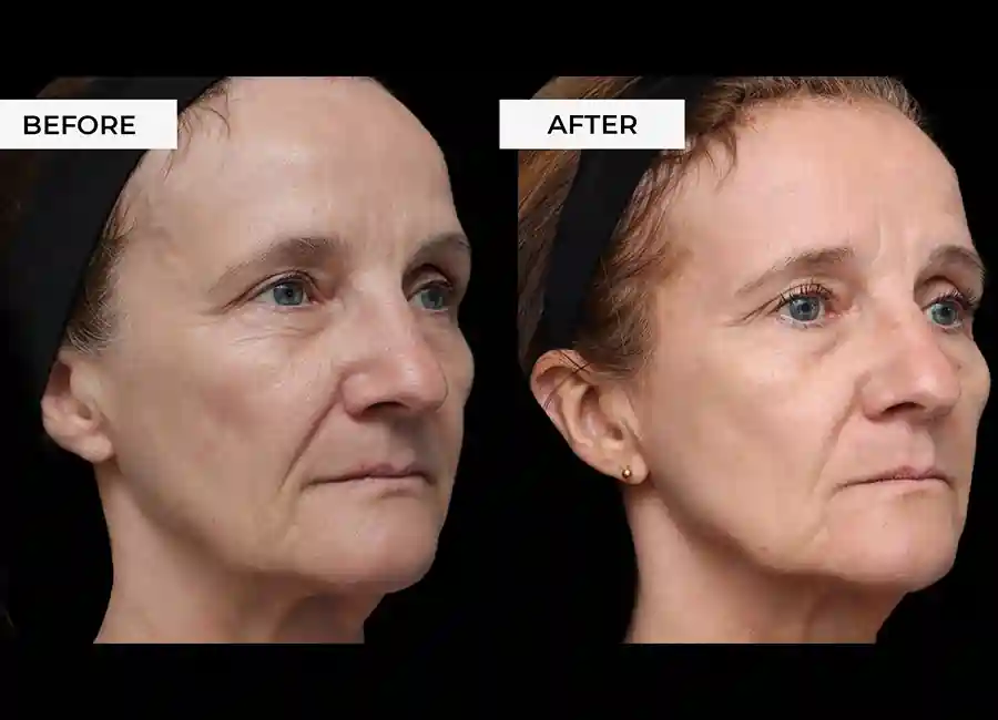How Many RF Microneedling Sessions Will You Need to See a Difference Falkirk?