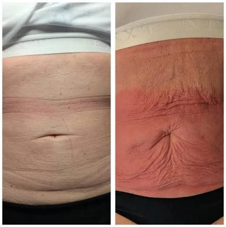 How Does RF Microneedling Improve Crepey, Thin and Uneven Skin Texture Falkirk?
