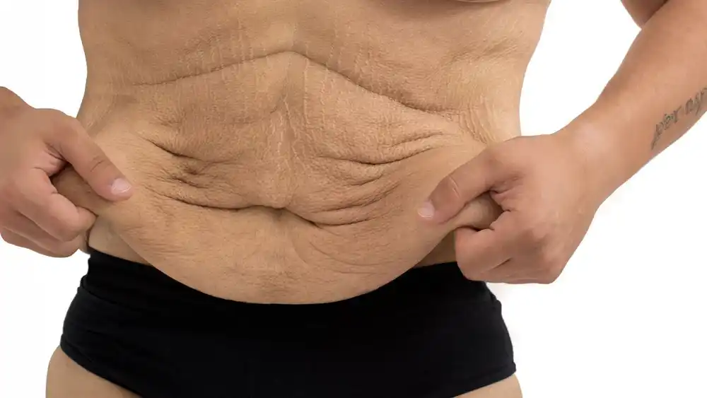 Why Does Weight Loss Medication Leave Some People With Loose or Sagging Skin Falkirk?